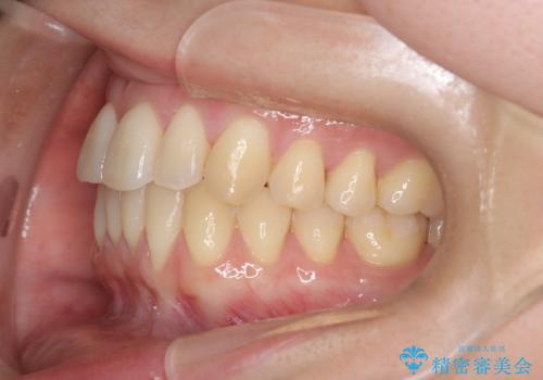 【インビザライン】反対咬合を治したいの治療後