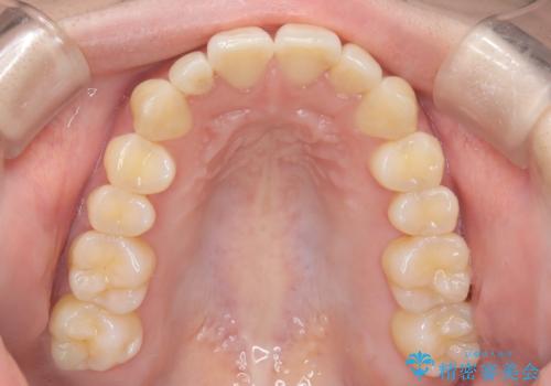 【インビザライン】反対咬合を治したいの治療後