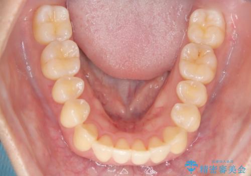 【インビザライン】反対咬合を治したいの治療後