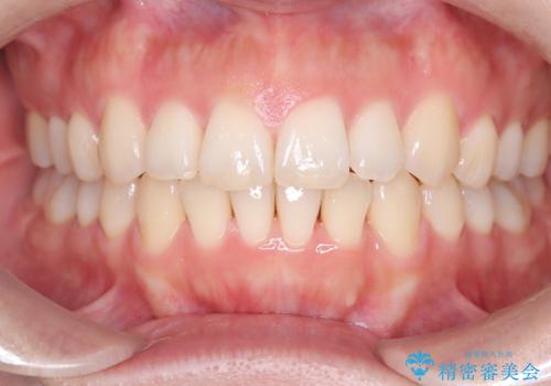 【インビザライン】前歯の凸凹を治したいの治療後