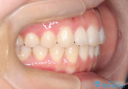 【インビザライン】前歯の凸凹を治したいの治療後