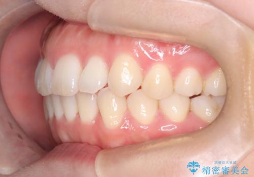 【インビザライン】前歯の凸凹を治したいの治療後