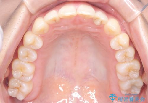 【インビザライン】前歯の凸凹を治したいの治療後