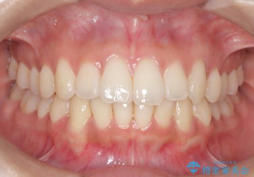【インビザライン】前歯の凸凹を綺麗にしたいの症例 治療後