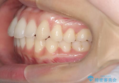 【インビザライン】前歯の凸凹を綺麗にしたいの治療後