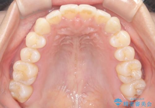 【インビザライン】前歯の凸凹を綺麗にしたいの治療後