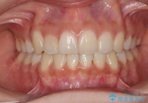 【審美装置】前歯の凸凹、抜歯矯正の症例 治療後