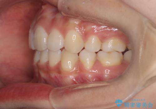 【審美装置】前歯の凸凹、抜歯矯正の治療後