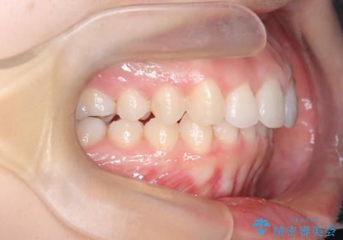 【インビザライン】前歯を引っ込めたいの治療後