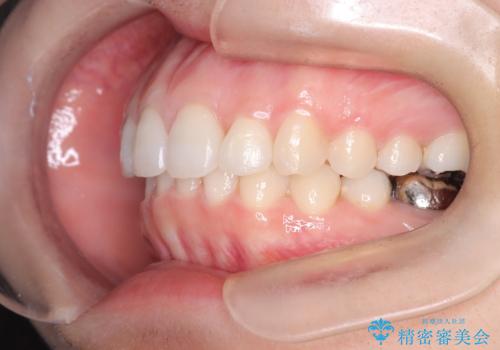 【インビザライン】前歯を引っ込めたいの治療後