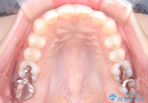 【インビザライン】前歯を引っ込めたいの治療後