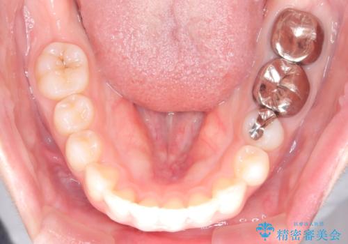 【インビザライン】前歯を引っ込めたいの治療後