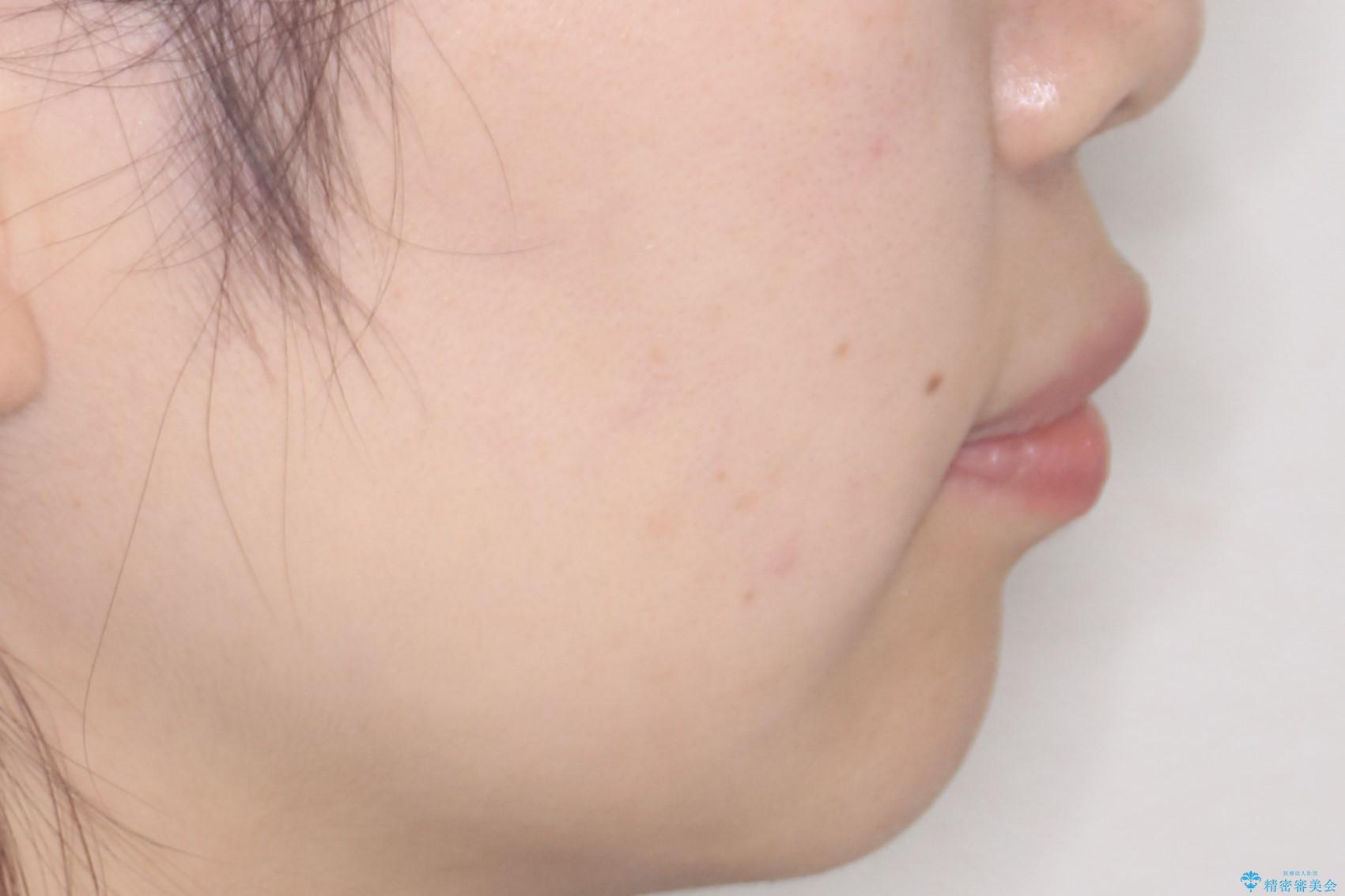 【インビザライン】前歯を引っ込めたいの治療後(顔貌)