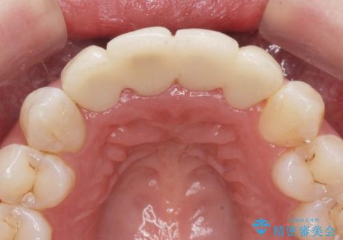 仮歯のまま放置していた前歯をセラミックにの治療前
