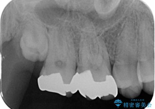 銀歯を白くしたいの治療前