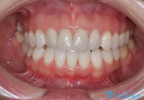 仮歯のまま放置していた前歯をセラミックにの治療後