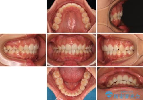 口が閉じられない 抜歯矯正で横顔の印象が劇的に変化の治療後