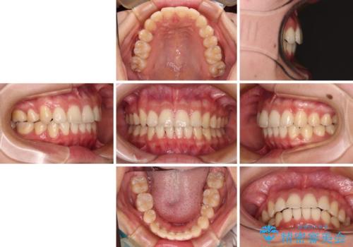 八重歯の抜歯矯正 補助装置とワイヤーを併用したインビザライン矯正治療の治療後