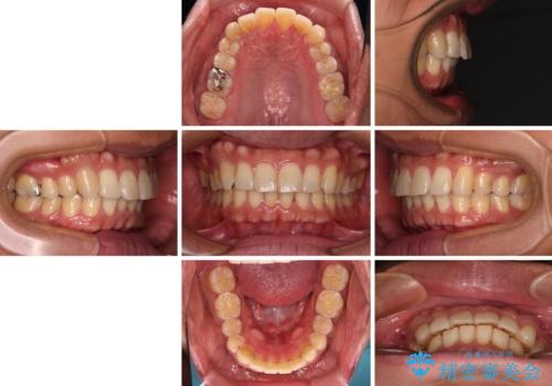 遠方からの通院 インビザライン矯正治療の治療後