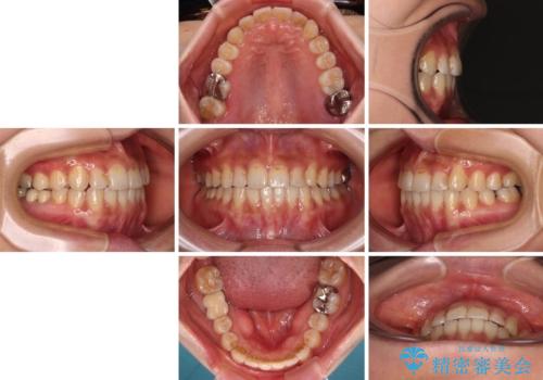 前歯のデコボコとクロスバイト インビザラインによる矯正治療の治療後
