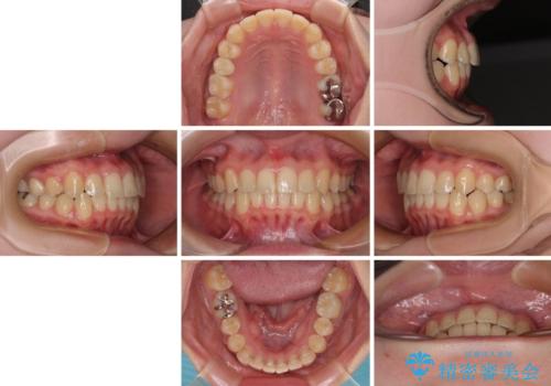 前歯のクロスバイト ギラギラのワイヤー装置で矯正治療の治療後