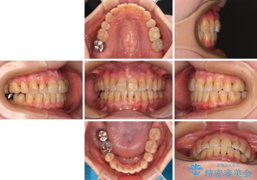 【モニター】前歯の突出感を抜歯矯正で改善の治療後