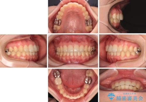 デコボコ歯列をきれいに インビザラインによる矯正治療の治療後