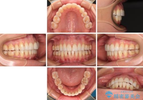 後戻りで突出した口元を引っ込めたい インビザライン矯正治療の治療後