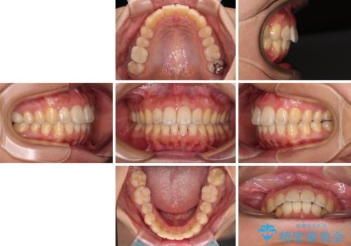 前に出ている前歯を引っ込めたい インビザライン矯正の治療後