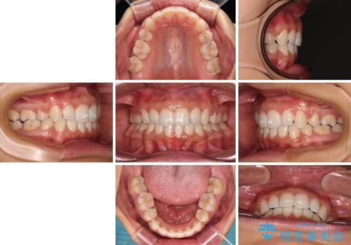 閉じにくい唇 抜歯矯正でスッキリした横顔にの治療後