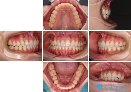 前歯のデコボコと深い咬み合わせ インビザラインできれいに改善の治療後