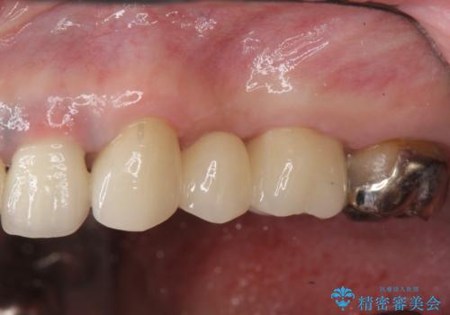 銀歯の見た目を改善、ジルコニア製セラミックブリッジの症例 治療後