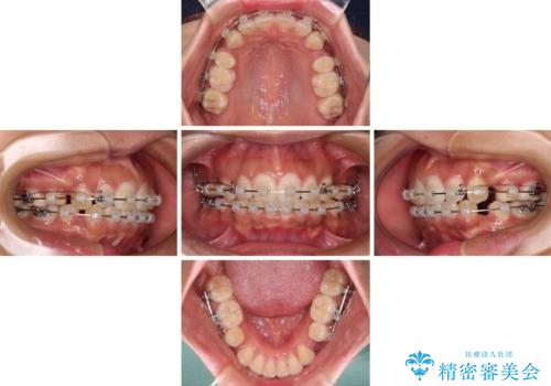 口が閉じられない 抜歯矯正で横顔の印象が劇的に変化の治療中