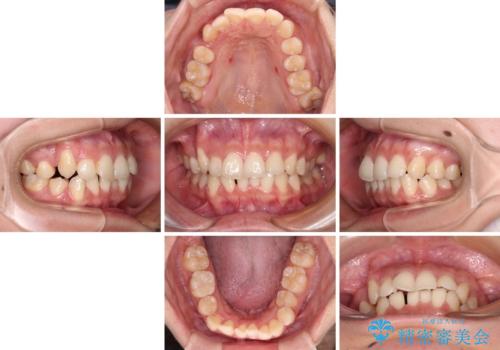 八重歯の抜歯矯正 補助装置とワイヤーを併用したインビザライン矯正治療の治療中