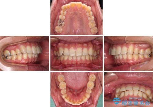 遠方からの通院 インビザライン矯正治療の治療中