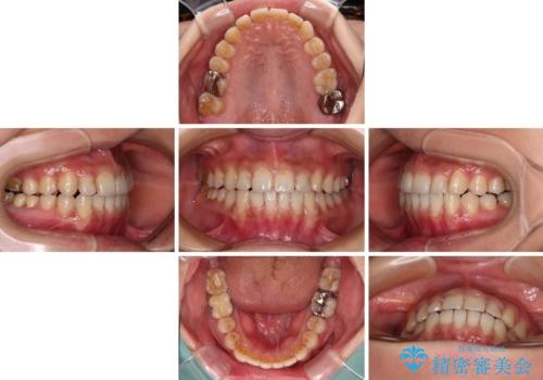 前歯のデコボコとクロスバイト　インビザラインによる矯正治療の治療中