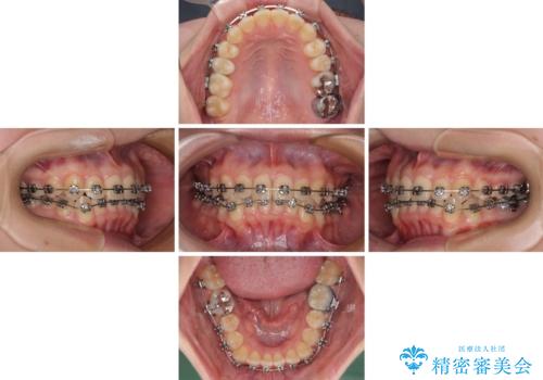 前歯のクロスバイト ギラギラのワイヤー装置で矯正治療の治療中