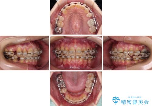 【モニター】前歯の突出感を抜歯矯正で改善の治療中