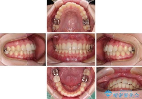 デコボコ歯列をきれいに インビザラインによる矯正治療の治療中