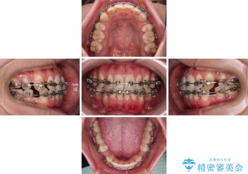 膨らんだ口元をスッキリと ワイヤー装置での抜歯矯正の治療中
