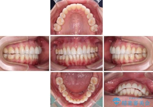 後戻りで突出した口元を引っ込めたい インビザライン矯正治療の治療中