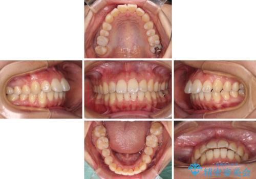 前に出ている前歯を引っ込めたい インビザライン矯正の治療中