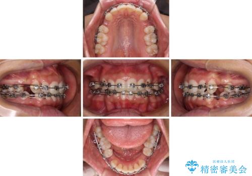 閉じにくい唇 抜歯矯正でスッキリした横顔にの治療中