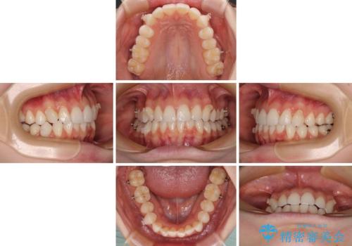 前歯のデコボコと深い咬み合わせ インビザラインできれいに改善の治療中