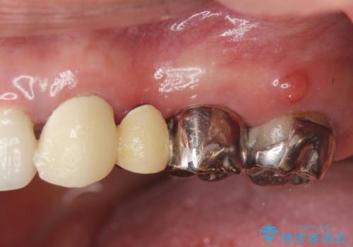 銀歯の見た目を改善、ジルコニア製セラミックブリッジの症例 治療前