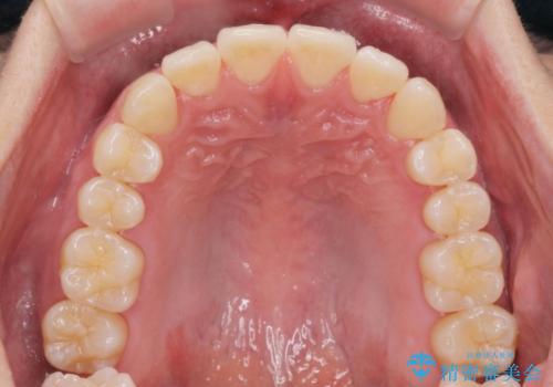 ワイヤー矯正がしたいの治療後