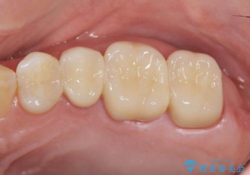 歯の神経を守る、精密な虫歯治療の実践の治療後