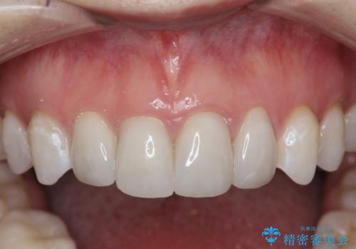 仮歯のまま放置していた前歯をセラミックにの治療後