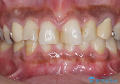 [ セラミック治療 ]   虫歯でつぎはぎになってしまった歯をきれいにしたいの治療前