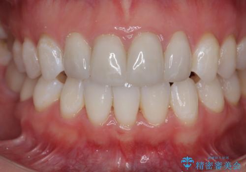 仮歯のまま放置していた前歯をセラミックにの治療後